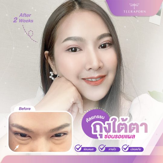 บอกลาตาแพนด้าถาวร พร้อมทำตาสองชั้น และ กำจัดถุงใต้ตา