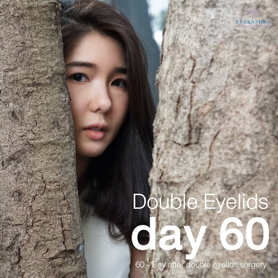 รีวิวทำตาสองชั้น ธีรพรคลินิก หมอชลธิศ